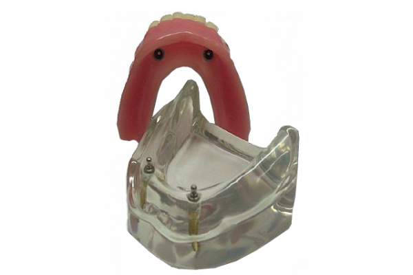 overdenture_infe_4ee7986097ac148EEBB95-3EAF-3BBC-DA3B-362C4DCE5461.png